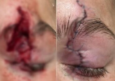 На Закарпатті хлопець отримав тяжку травму повіки під час необережної гри