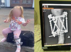 У Закарпатській обласній дитячій лікарні успішно завершено лікування ортопедичної патології у дитини