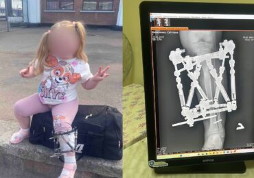 У Закарпатській обласній дитячій лікарні успішно завершено лікування ортопедичної патології у дитини