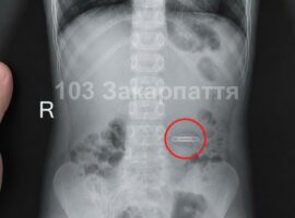 На Тячівщині 5-річний хлопчик проковтнув металеву скріпку: дитину госпіталізували до обласної лікарні