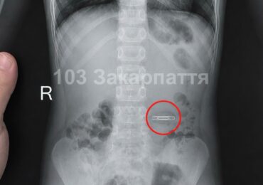 На Тячівщині 5-річний хлопчик проковтнув металеву скріпку: дитину госпіталізували до обласної лікарні
